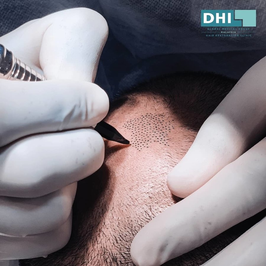 DHI-Direct Hair Implantation - DHI-Direct Hair Implantation