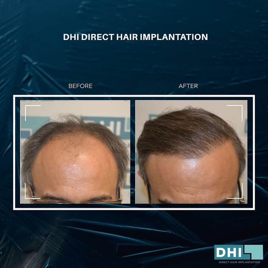 DHI-Direct Hair Implantation - DHI-Direct Hair Implantation