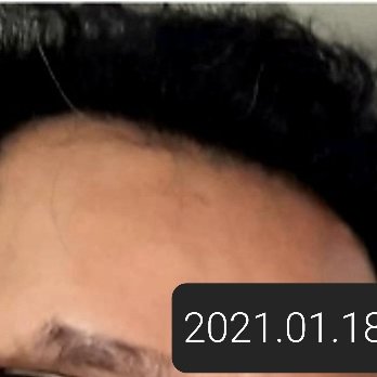 DHI-Direct Hair Implantation - DHI-Direct Hair Implantation