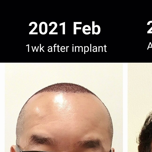 DHI-Direct Hair Implantation - DHI-Direct Hair Implantation