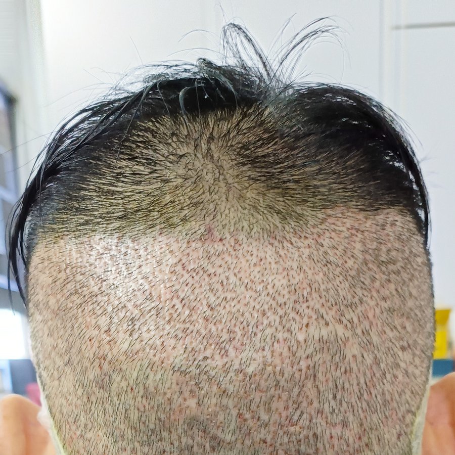 DHI-Direct Hair Implantation - DHI-Direct Hair Implantation