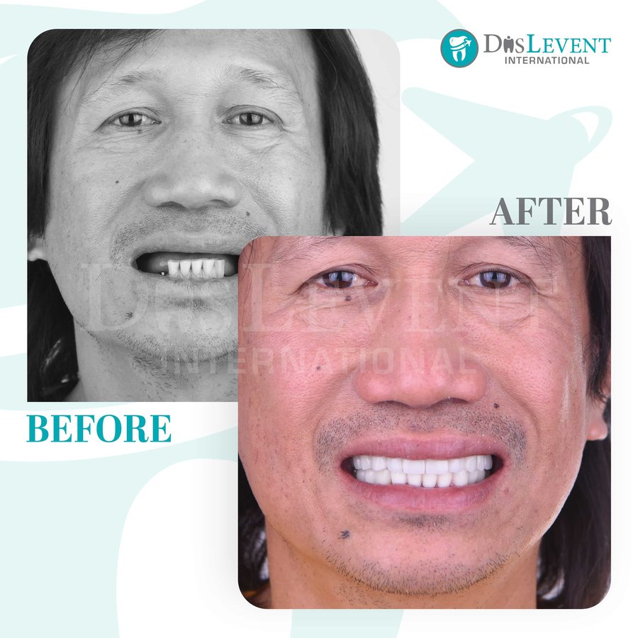 عيادة ديفينت الدولية - DIS Levent International Clinic