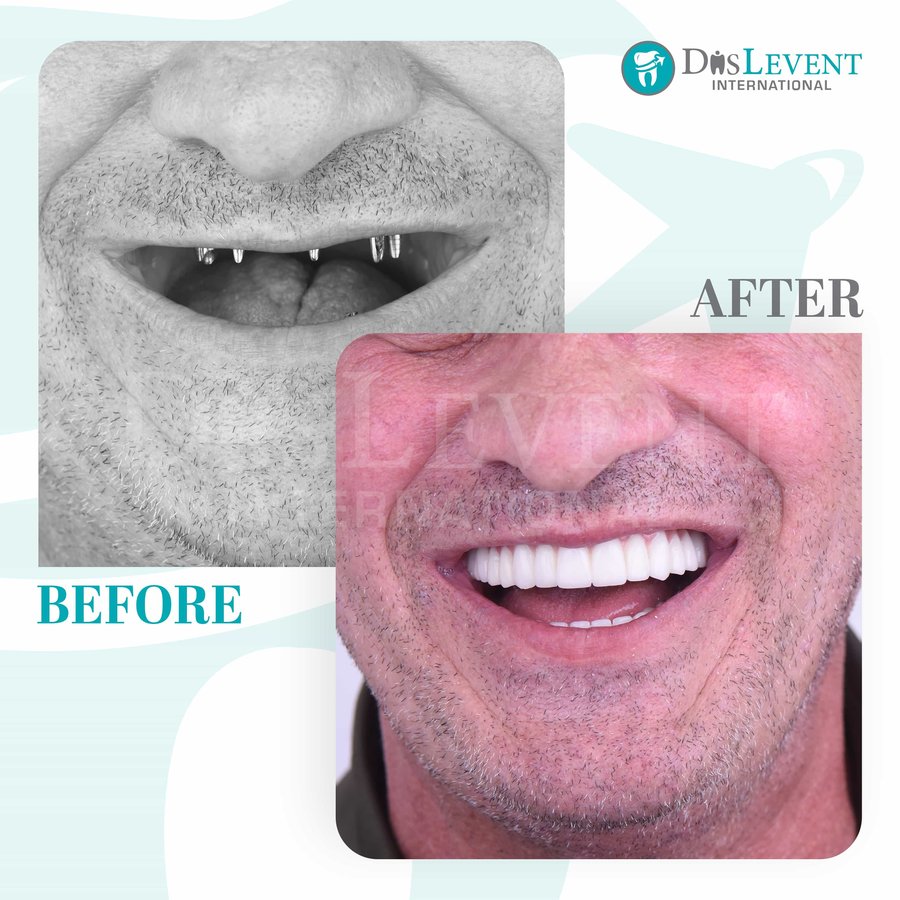 عيادة ديفينت الدولية - DIS Levent International Clinic