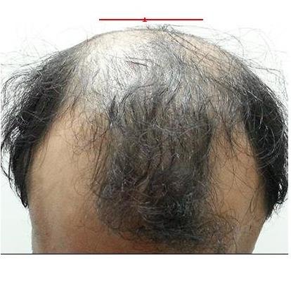 Downtown Hair Transplant Clinic - Downtown Hair Transplant Clinic