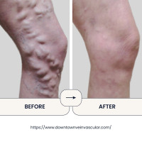 Downtown Vein Treatment Center - Downtown Vein Treatment Center