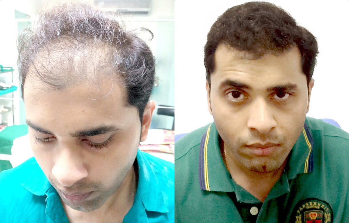 الدكتور أنجالي شير الشعر العلوم تشيناي - Dr Anjali Shere's Hair Science Chennai