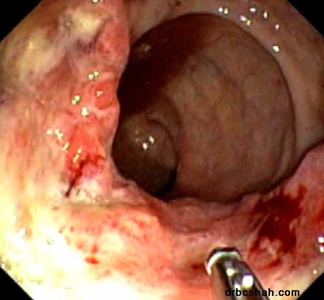 Dr. B. C. Shah Laparoscopic and General Surgeon - Dr. B. C. Shah Laparoscopic and General Surgeon