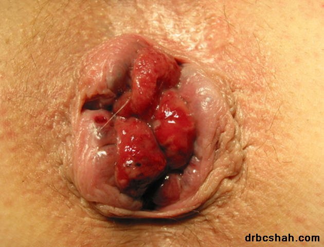 Dr. B. C. Shah Laparoscopic and General Surgeon - Dr. B. C. Shah Laparoscopic and General Surgeon