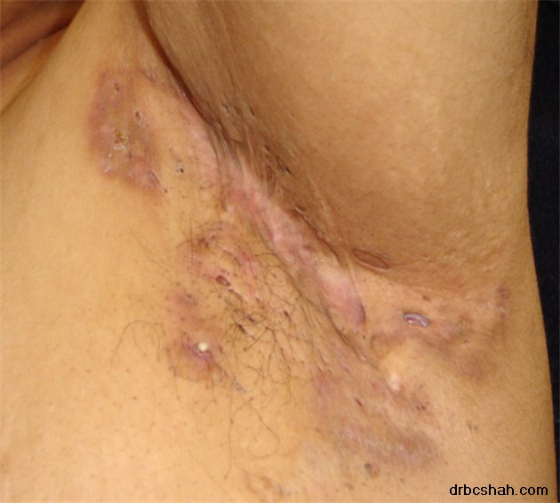 Dr. B. C. Shah Laparoscopic and General Surgeon - Dr. B. C. Shah Laparoscopic and General Surgeon