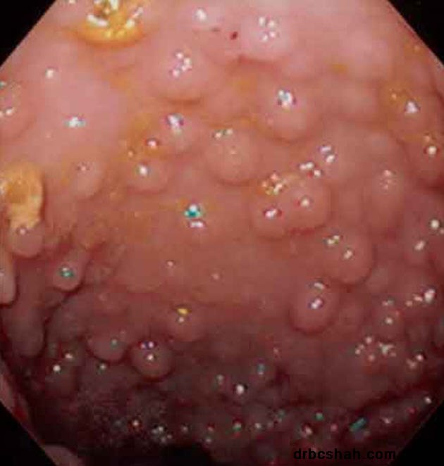 Dr. B. C. Shah Laparoscopic and General Surgeon - Dr. B. C. Shah Laparoscopic and General Surgeon