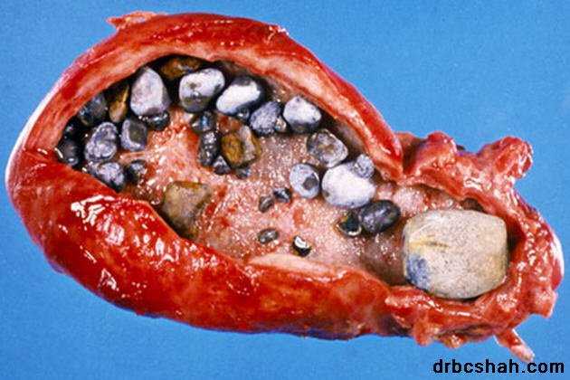 Dr. B. C. Shah Laparoscopic and General Surgeon - Dr. B. C. Shah Laparoscopic and General Surgeon