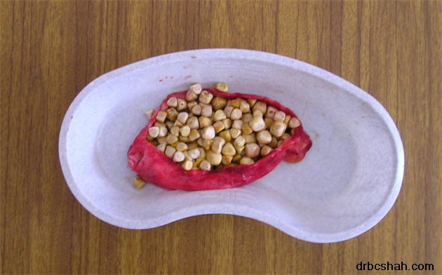 Dr. B. C. Shah Laparoscopic and General Surgeon - Dr. B. C. Shah Laparoscopic and General Surgeon