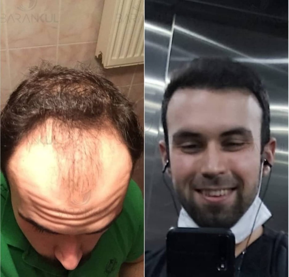 Dr Baran Kul - Hair Transplant - Dr Baran Kul - Hair Transplant