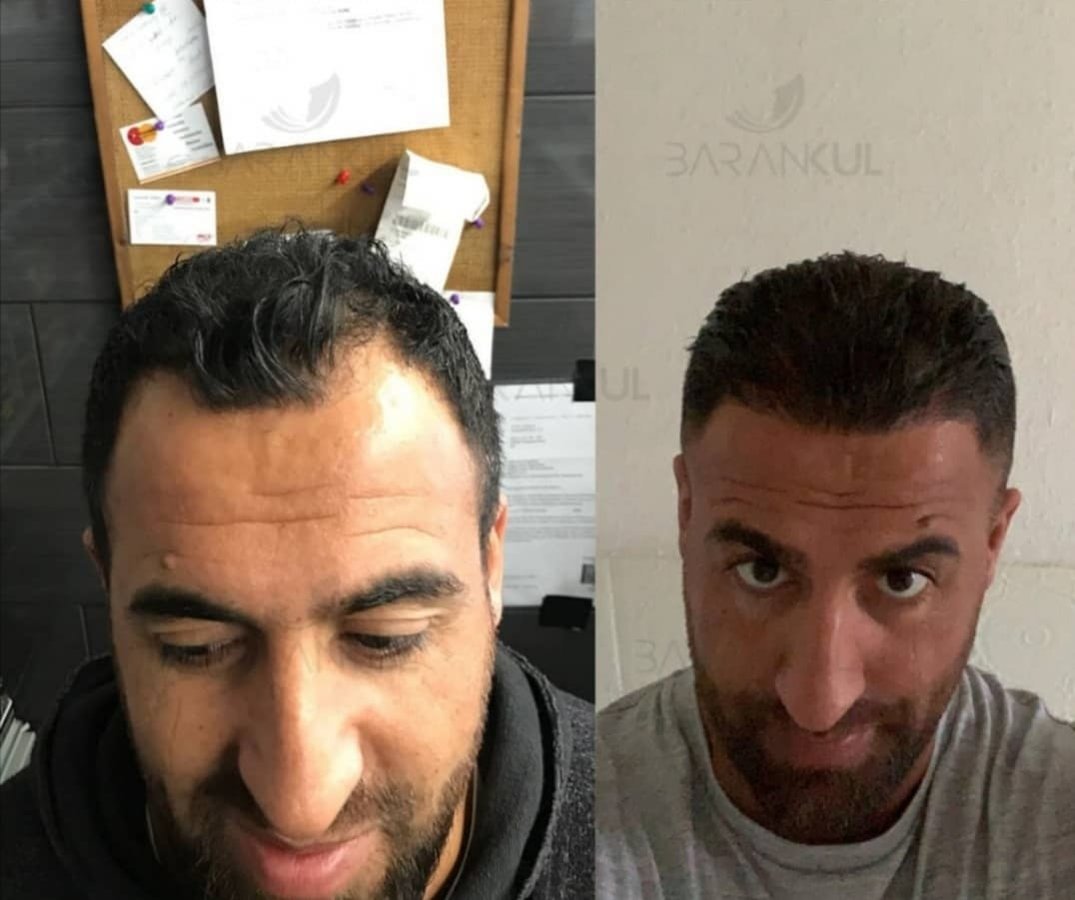 Dr Baran Kul - Hair Transplant - Dr Baran Kul - Hair Transplant