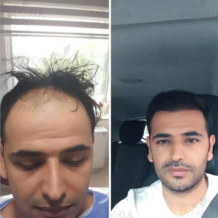 Dr Baran Kul - Hair Transplant - Dr Baran Kul - Hair Transplant