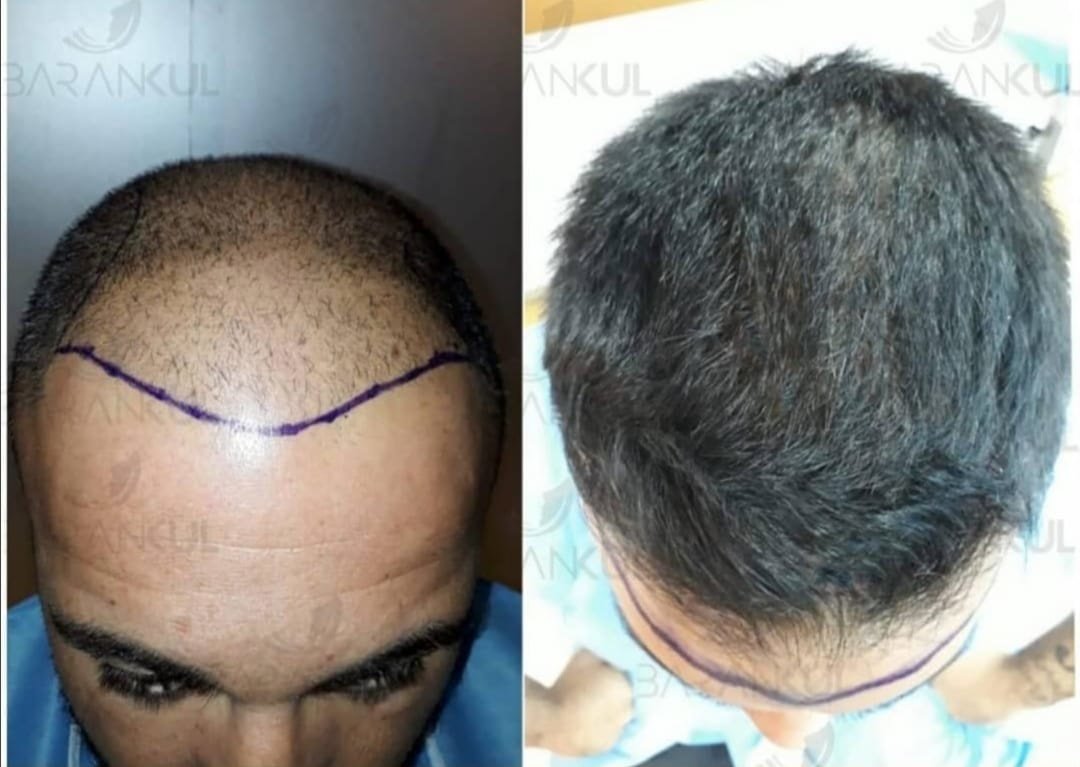 Dr Baran Kul - Hair Transplant - Dr Baran Kul - Hair Transplant