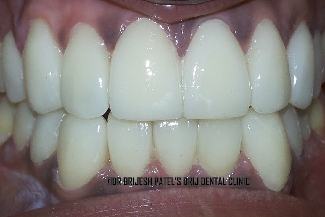 Dr Brijesh Patel’s Brij Dental Clinic & Implant ce - Dr Brijesh Patel’s Brij Dental Clinic & Implant ce