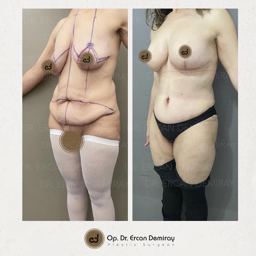 Dr Ercan Demiray MD, Aesthetic and Plastic Surgeon - Dr Ercan Demiray MD, Aesthetic and Plastic Surgeon