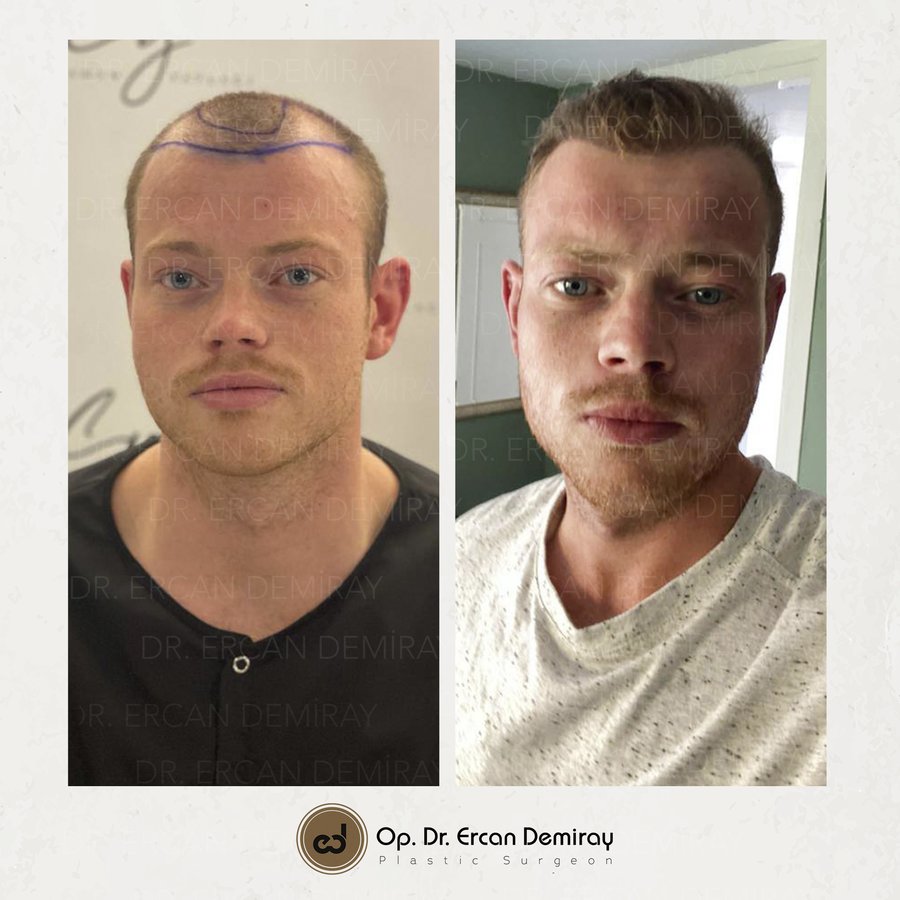 Dr Ercan Demiray MD, Aesthetic and Plastic Surgeon - Dr Ercan Demiray MD, Aesthetic and Plastic Surgeon