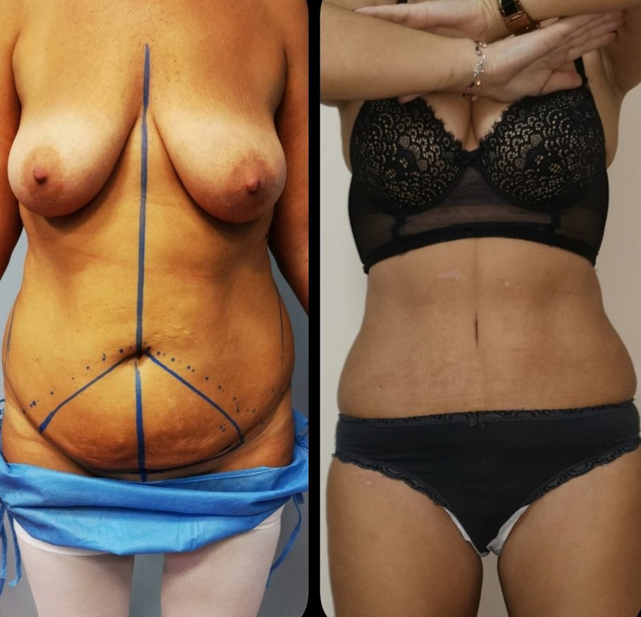 Dr Fotios Filippos Karantonis Plastic Surgery - Dr Fotios Filippos Karantonis Plastic Surgery