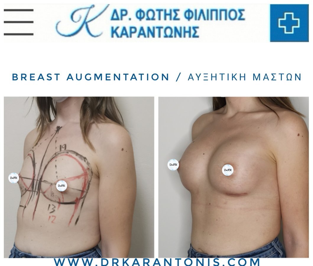 Dr Fotios Filippos Karantonis Plastic Surgery - Dr Fotios Filippos Karantonis Plastic Surgery