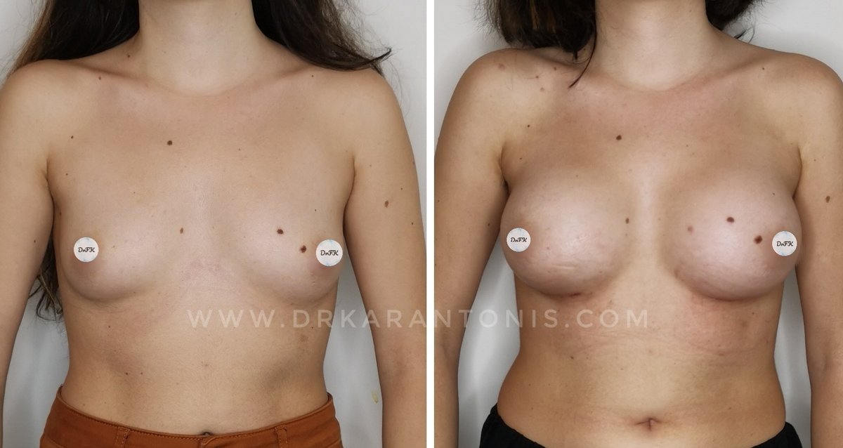 Dr Fotios Filippos Karantonis Plastic Surgery - Dr Fotios Filippos Karantonis Plastic Surgery