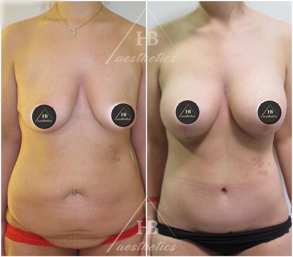 DR. M. HAKAN BULAM AESTHETIC PLASTIC SURGERY - DR. M. HAKAN BULAM AESTHETIC PLASTIC SURGERY