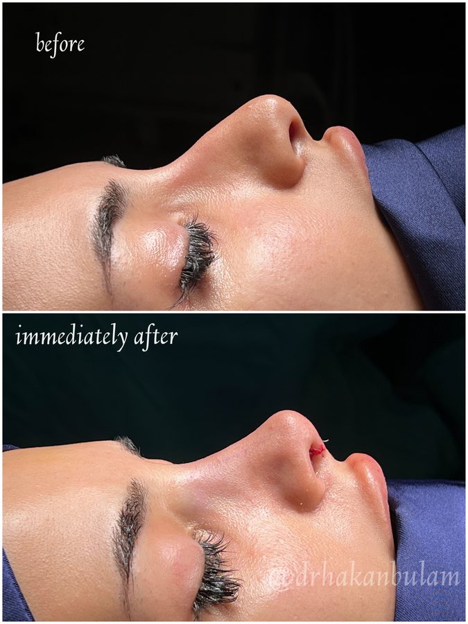 DR. M. HAKAN BULAM AESTHETIC PLASTIC SURGERY - DR. M. HAKAN BULAM AESTHETIC PLASTIC SURGERY