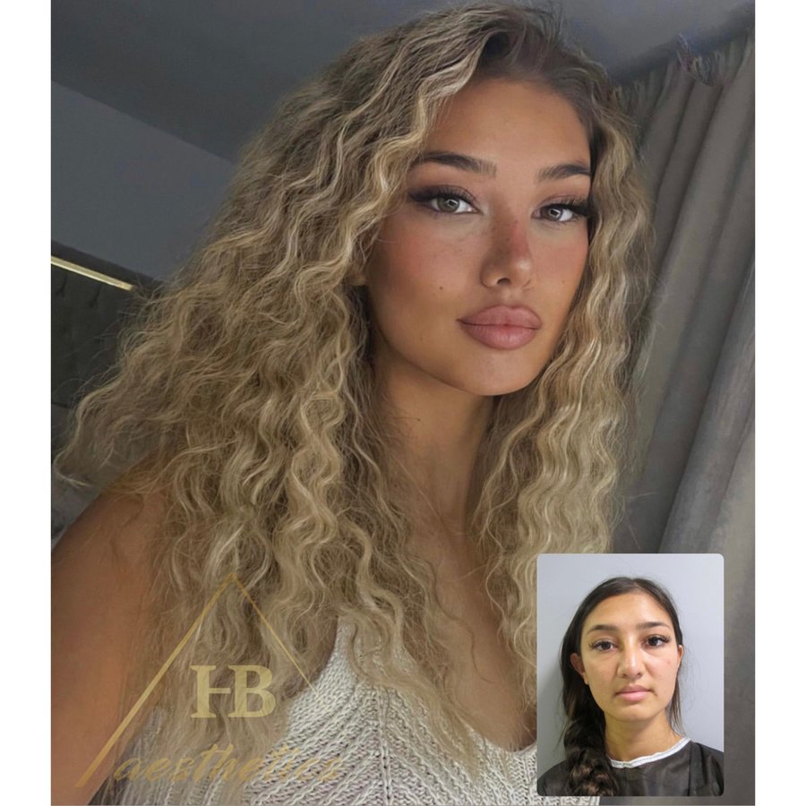 DR. M. HAKAN BULAM AESTHETIC PLASTIC SURGERY - DR. M. HAKAN BULAM AESTHETIC PLASTIC SURGERY