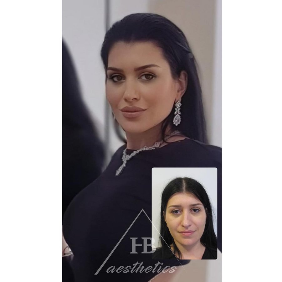 DR. M. HAKAN BULAM AESTHETIC PLASTIC SURGERY - DR. M. HAKAN BULAM AESTHETIC PLASTIC SURGERY