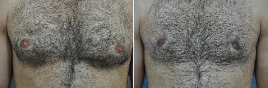 Dr. R. K. Mishra- Plastic & Cosmetic Surgeon -SIPS - Dr. R. K. Mishra- Plastic & Cosmetic Surgeon -SIPS