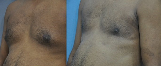 Dr. R. K. Mishra- Plastic & Cosmetic Surgeon -SIPS - Dr. R. K. Mishra- Plastic & Cosmetic Surgeon -SIPS