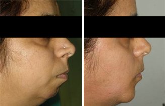Dr. R. K. Mishra- Plastic & Cosmetic Surgeon -SIPS - Dr. R. K. Mishra- Plastic & Cosmetic Surgeon -SIPS