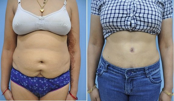 Dr. R. K. Mishra- Plastic & Cosmetic Surgeon -SIPS - Dr. R. K. Mishra- Plastic & Cosmetic Surgeon -SIPS