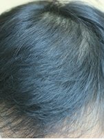 Dr. Shin-Je Lee (Dr. Momo) Hair Transplant International - Dr. Shin-Je Lee (Dr. Momo) Hair Transplant International