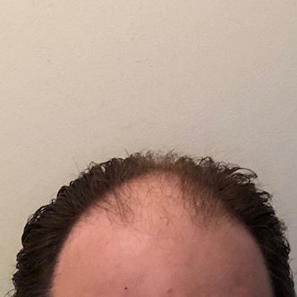 Dr. Shin-Je Lee (Dr. Momo) Hair Transplant International - Dr. Shin-Je Lee (Dr. Momo) Hair Transplant International