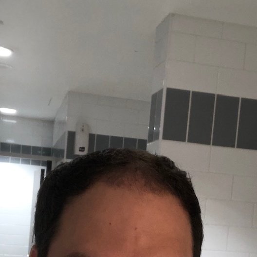 Dr. Shin-Je Lee (Dr. Momo) Hair Transplant International - Dr. Shin-Je Lee (Dr. Momo) Hair Transplant International