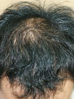 Dr. Shin-Je Lee (Dr. Momo) Hair Transplant International - Dr. Shin-Je Lee (Dr. Momo) Hair Transplant International