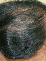 Dr. Shin-Je Lee (Dr. Momo) Hair Transplant International - Dr. Shin-Je Lee (Dr. Momo) Hair Transplant International