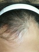 Dr. Shin-Je Lee (Dr. Momo) Hair Transplant International - Dr. Shin-Je Lee (Dr. Momo) Hair Transplant International