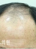 Dr. Shin-Je Lee (Dr. Momo) Hair Transplant International - Dr. Shin-Je Lee (Dr. Momo) Hair Transplant International