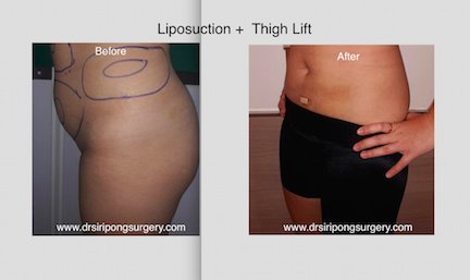 Dr Siripong Surgery - Dr Siripong Surgery