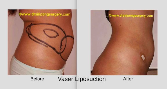 Dr Siripong Surgery - Dr Siripong Surgery