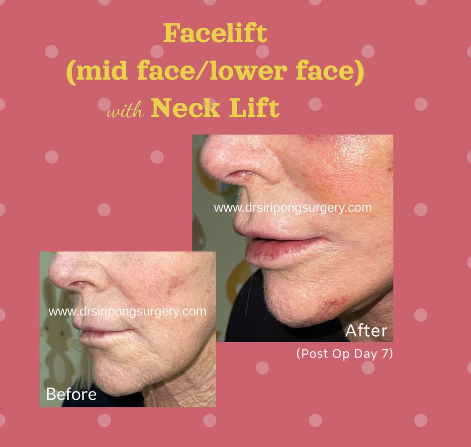 Dr Siripong Surgery - Dr Siripong Surgery