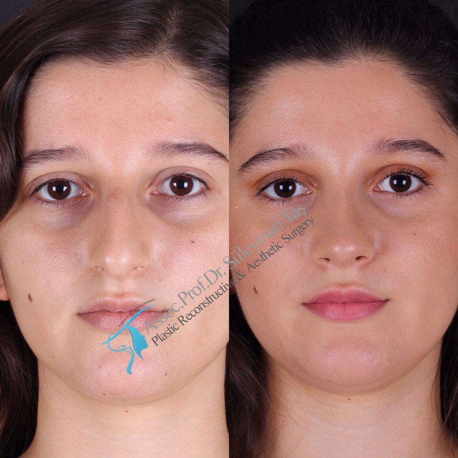 Dr. Suleyman Tas MD, Aesthetic and Plastic Surgeon - Dr. Suleyman Tas MD, Aesthetic and Plastic Surgeon