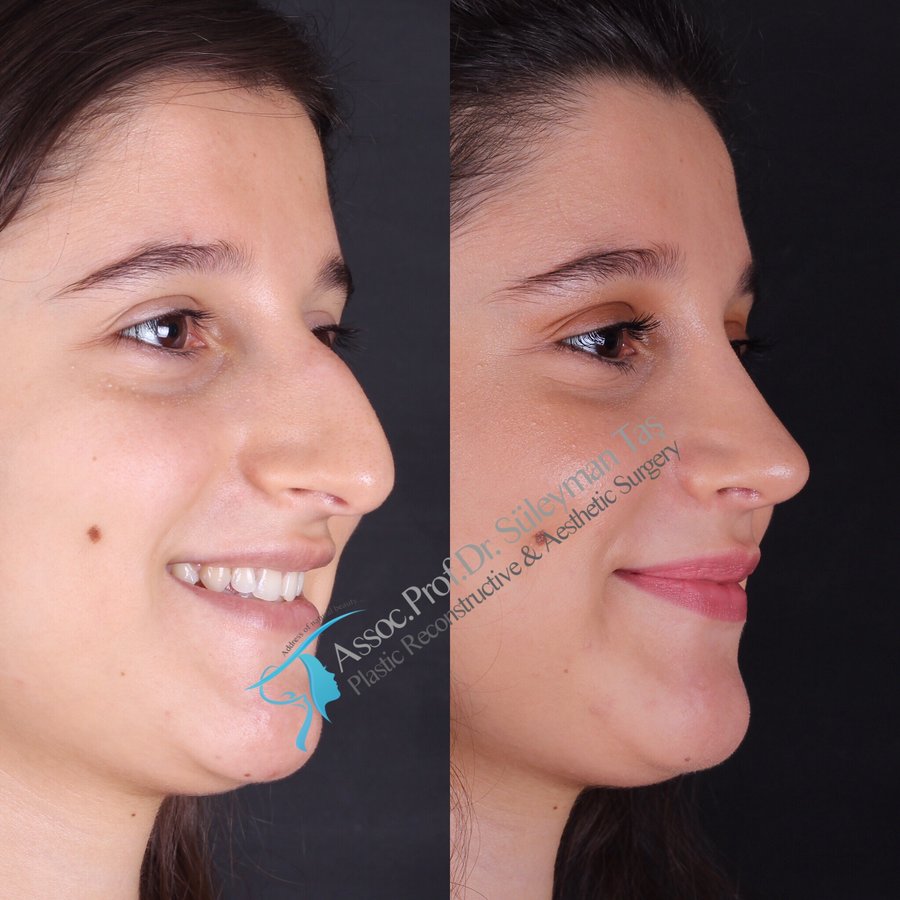 Dr. Suleyman Tas MD, Aesthetic and Plastic Surgeon - Dr. Suleyman Tas MD, Aesthetic and Plastic Surgeon