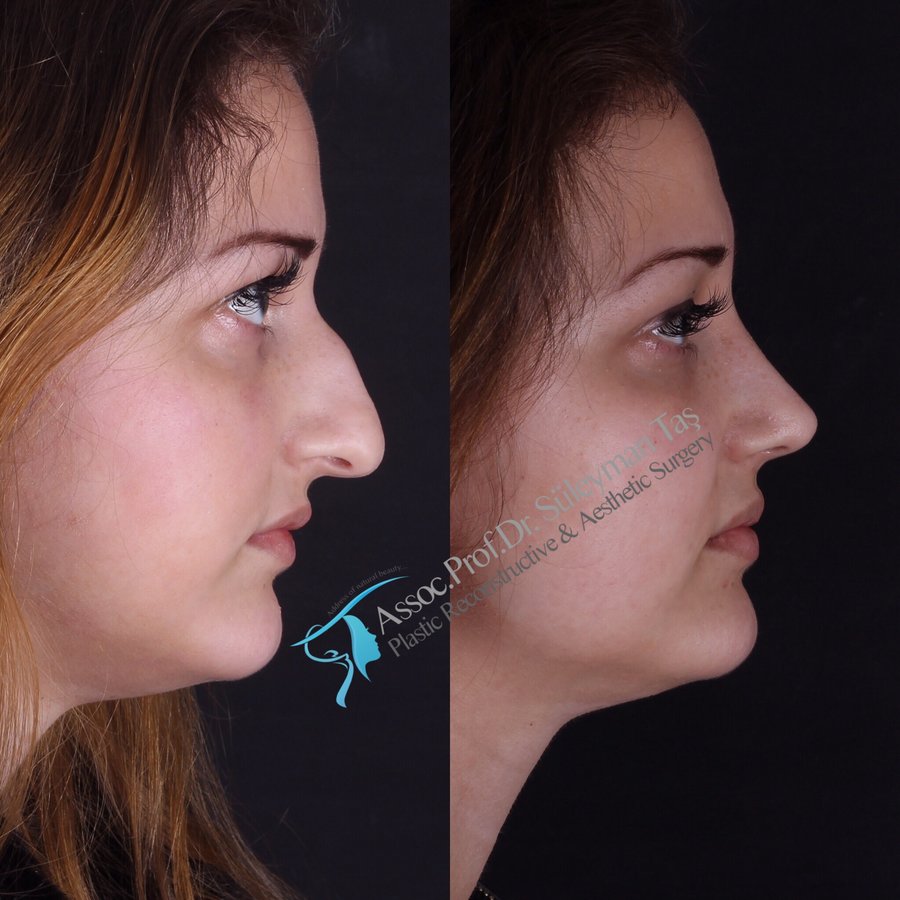 Dr. Suleyman Tas MD, Aesthetic and Plastic Surgeon - Dr. Suleyman Tas MD, Aesthetic and Plastic Surgeon