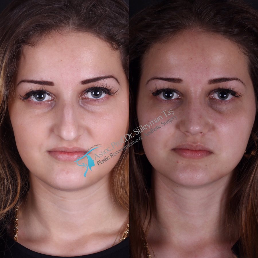 Dr. Suleyman Tas MD, Aesthetic and Plastic Surgeon - Dr. Suleyman Tas MD, Aesthetic and Plastic Surgeon