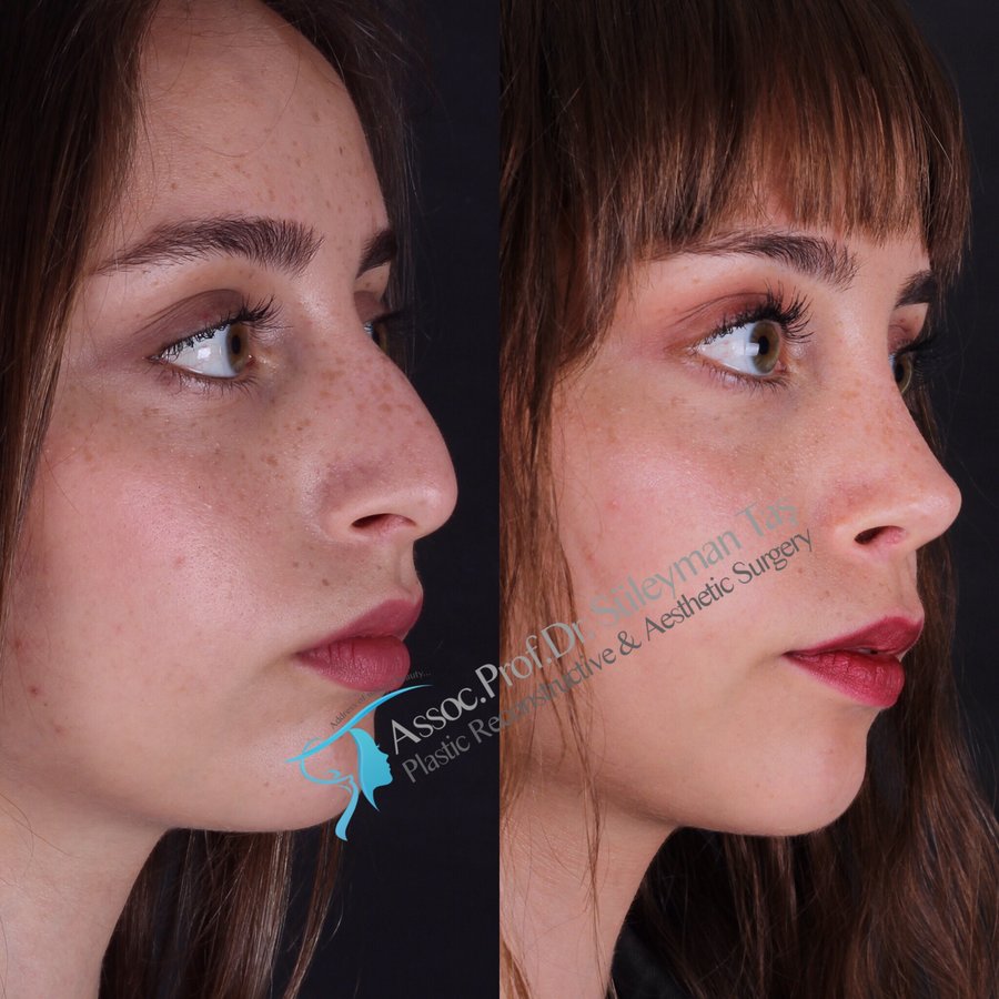 Dr. Suleyman Tas MD, Aesthetic and Plastic Surgeon - Dr. Suleyman Tas MD, Aesthetic and Plastic Surgeon