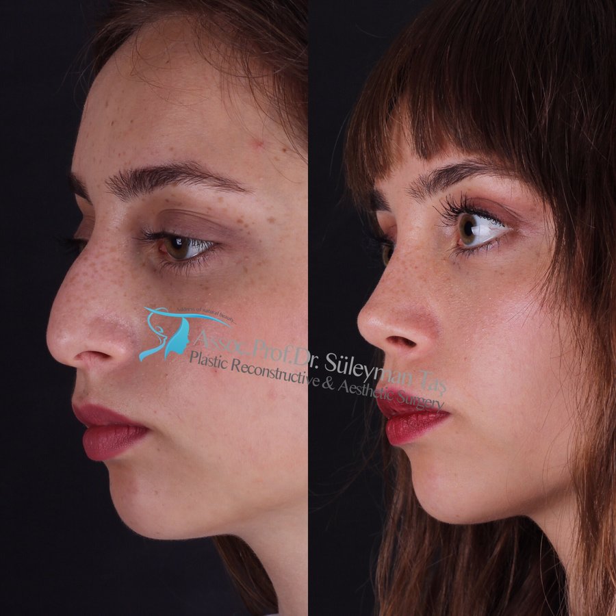 Dr. Suleyman Tas MD, Aesthetic and Plastic Surgeon - Dr. Suleyman Tas MD, Aesthetic and Plastic Surgeon